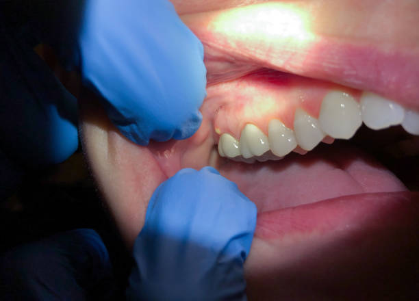 Best Knocked-Out Tooth Emergency  in Trion, GA